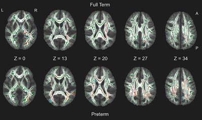 Executive Function in Relation to White Matter in Preterm and Full Term Children